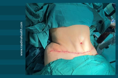 Tummy Tuck in Iran