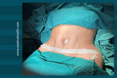Abdominoplasty Surgery in Iran