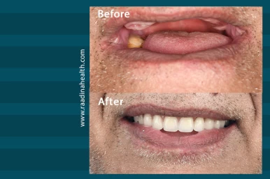 Dental implants in Iran professionally