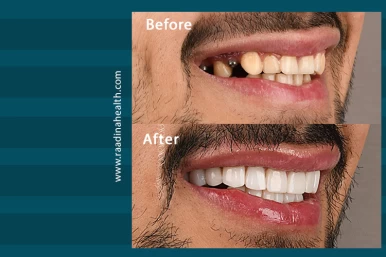 Dental Implant Surgery in Iran