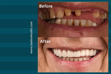 Before and after of dental implant surgery in Iran