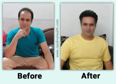 Hair Transplant in Iran