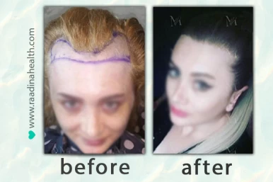 Before and after Hair Transplant
