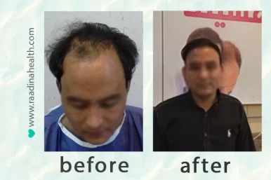 Hair Transplant Results in Iran