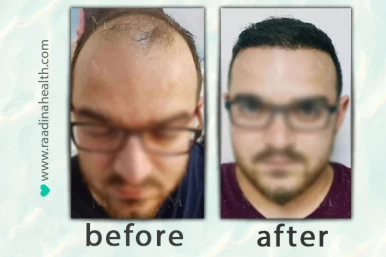 Hair Transplant Before and After Photos