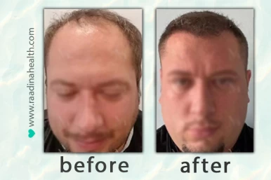 Hair Transplant in Iran Before After