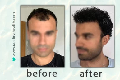 Hair Transplant Before and After