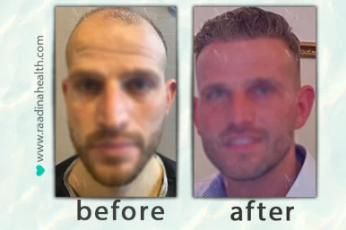 Hair Transplant Before & After Photos