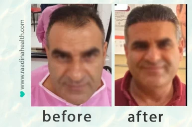 Hair Transplant Results: Before and After