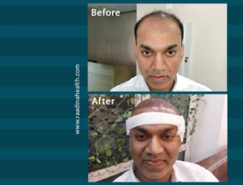 Iranian Hair Transplant before and after