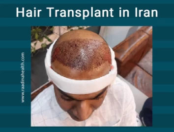Hair Transplant Surgery in Iran
