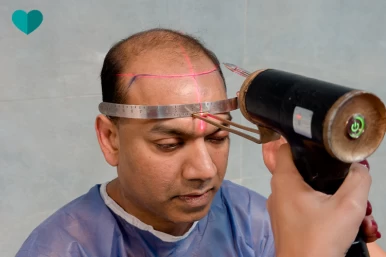 Hair Transplant in Iran