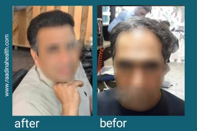 Hair Transplant Before and After