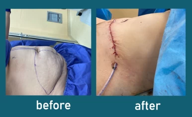 Tummy Tuck Surgery in Iran