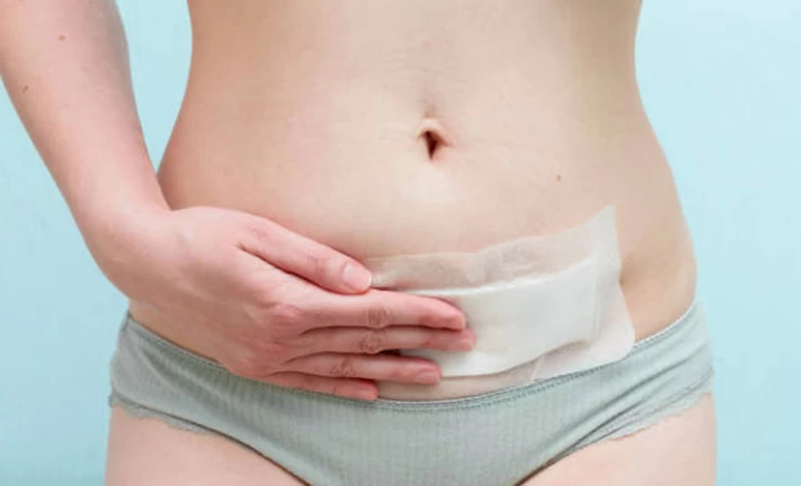 Tummy tuck wound care