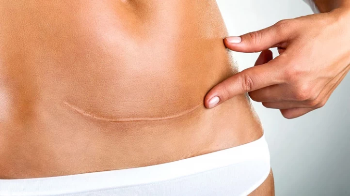 Suture place after Tummy tuck