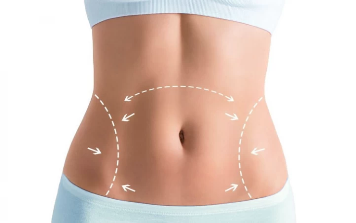 Tummy Tuck