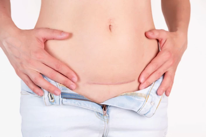 tummy tuck recovery