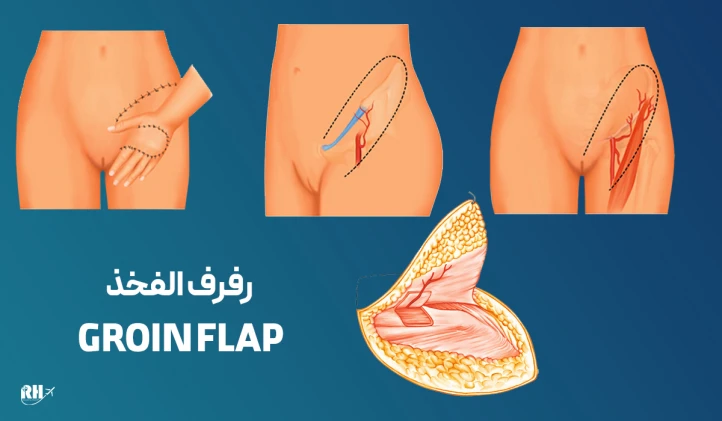Groin Flap