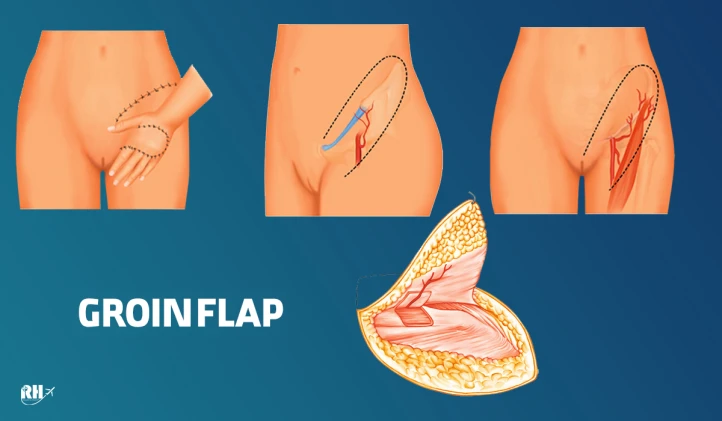 Groin Flap