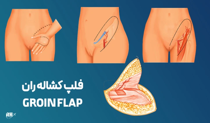 فلپ کشاله ران