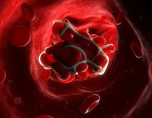 روش های مقابله با آمبولی روش های مقابله با آمبولی