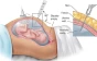 آزمایش آمنیوسنتز (Amniocentesis)