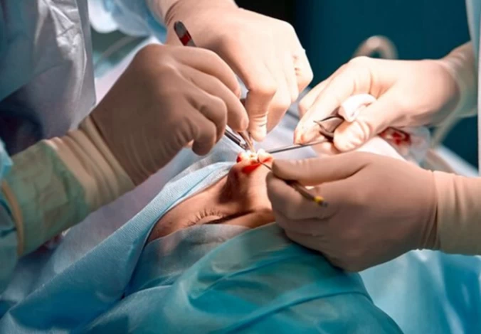 Nasal polypectomy clearance procedure