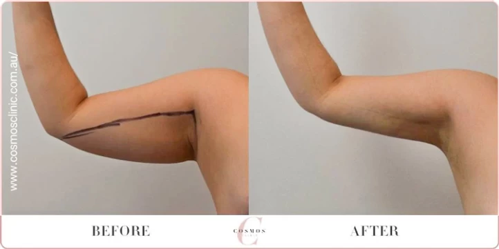 Arm Liposuction Recovery