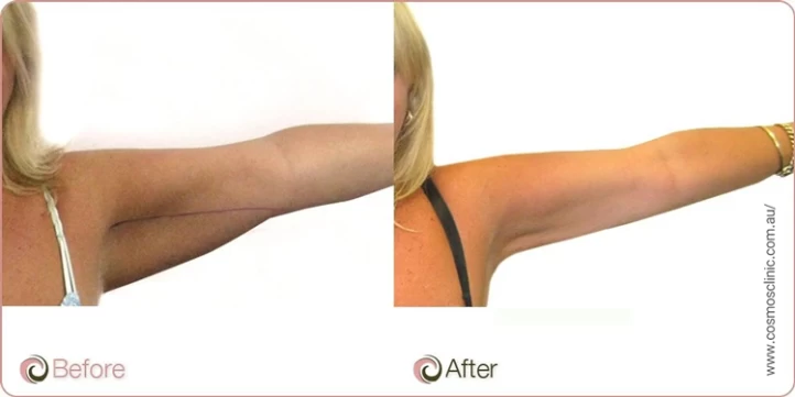 Is Arm Liposuction Surgery Worth It? - Raadina Health