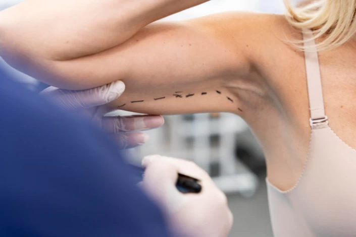 Arm Liposuction Recovery