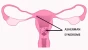 Asherman Syndrome