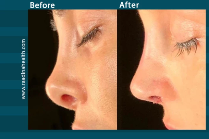 bad rhinoplasty before and after