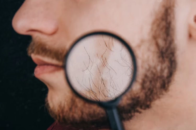 Beard Transplant Surgery