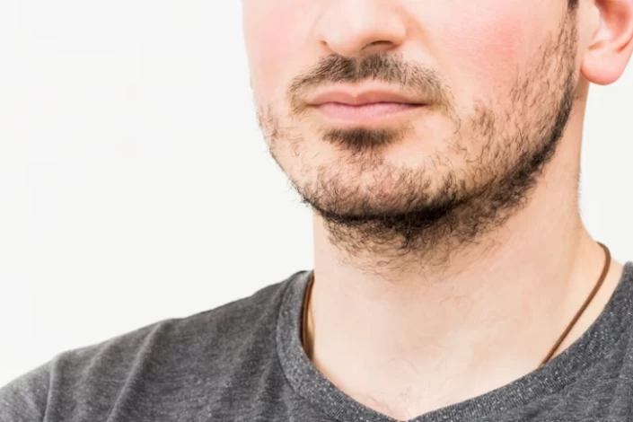 How Long Does It Take to Recover from Beard Transplant? How Long Does It Take to Recover from Beard Transplant?