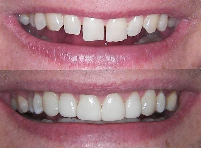 Understanding the Impact of Veneers on your Tooth Composite Veneers Before and After