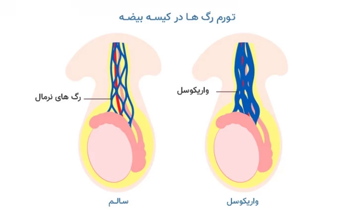 واریکوسل و تأثیر آن بر باروری مردان