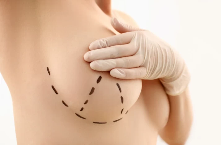 Breast Augmentation and Athletes: What You Need to Know - Ali