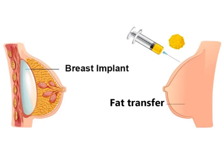 Breast Implants Vs Fat Transfer