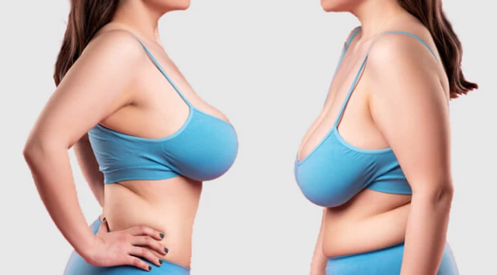 Video: Woman has surgrey to reduce her 38H cup breasts
