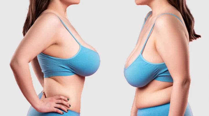 Woman's boobs expand NINE cup sizes to 40L after she has