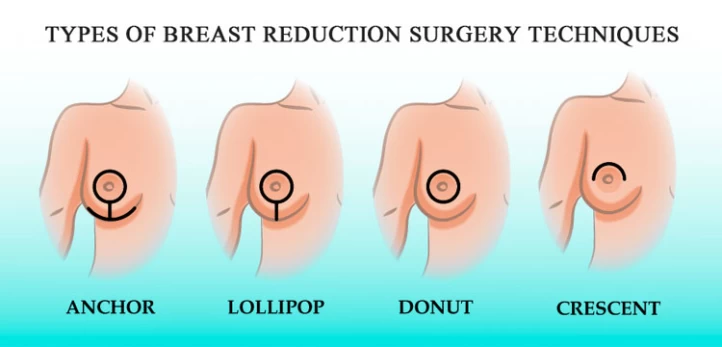 Breast reduction (mammoplasty) - Series—Indications: MedlinePlus Medical  Encyclopedia