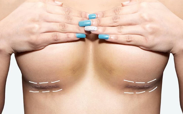 Do Breast Reduction Scars Go Away? - Raadina Health