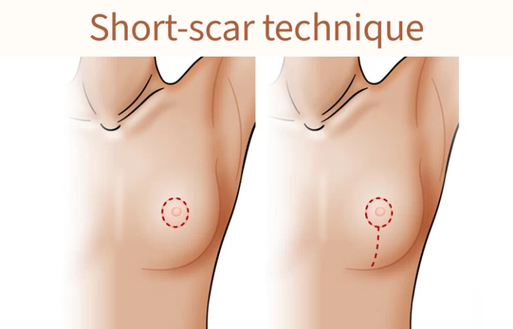 Surgical incisions for reduction mammoplasty. (a) An incision is