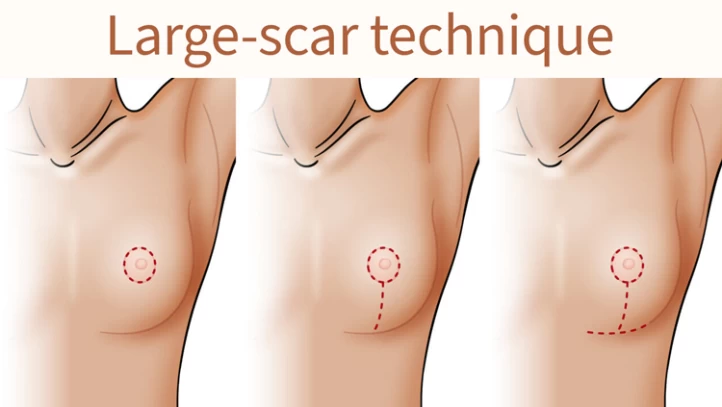 What Will My Scars Look Like After Breast Lift Surgery?