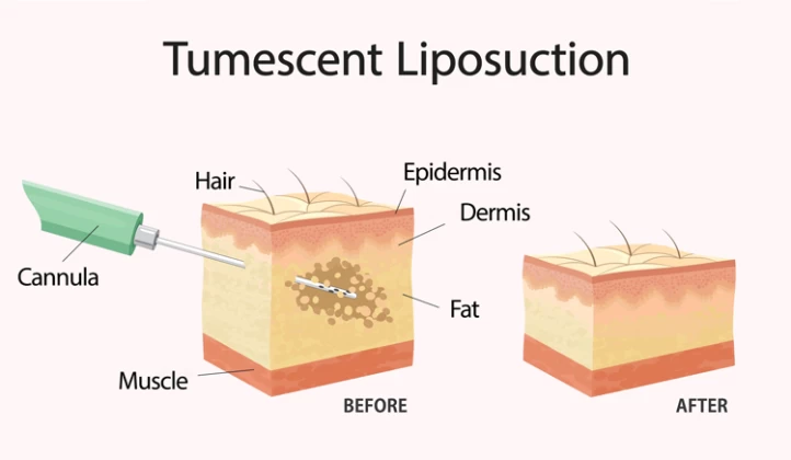 Liposuction vs. Microcannula Tumescent Liposuction: What's the Difference?, Irvine Liposuction & Microcannula Tumescent Liposuction