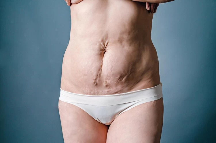 After Liposuction Foam Post Surgery Compression Sticky Back Tummy