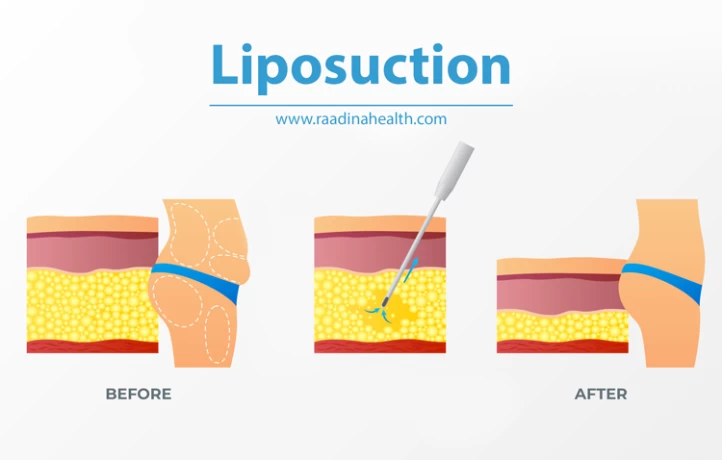 5 Way to Get rid of Lumps After Liposuction - Raadina Health