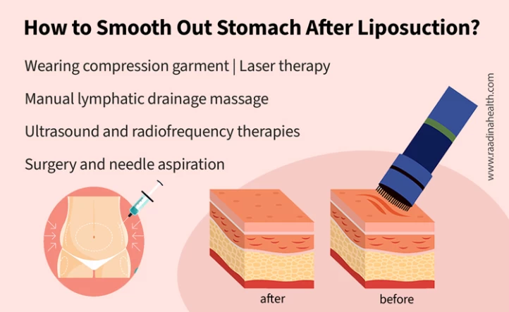 Bumps and lumps after abdominal lipo (2) : r/PlasticSurgery