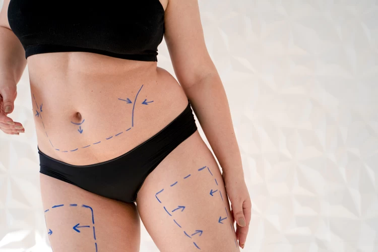 Liposuction is one of the most common surgical methods for weight loss.